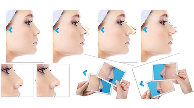 Nâng mũi bằng chỉ Nâng mũi bằng chỉ