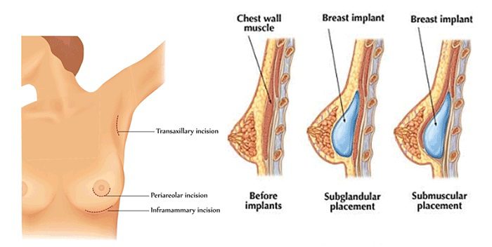 Nâng ngực không phẫu thuật bằng filler