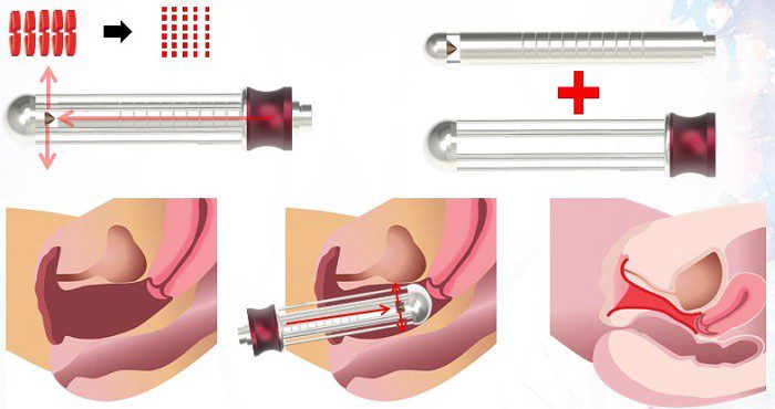 Thu hẹp vùng kín sau sinh Thu hẹp vùng kín sau sinh